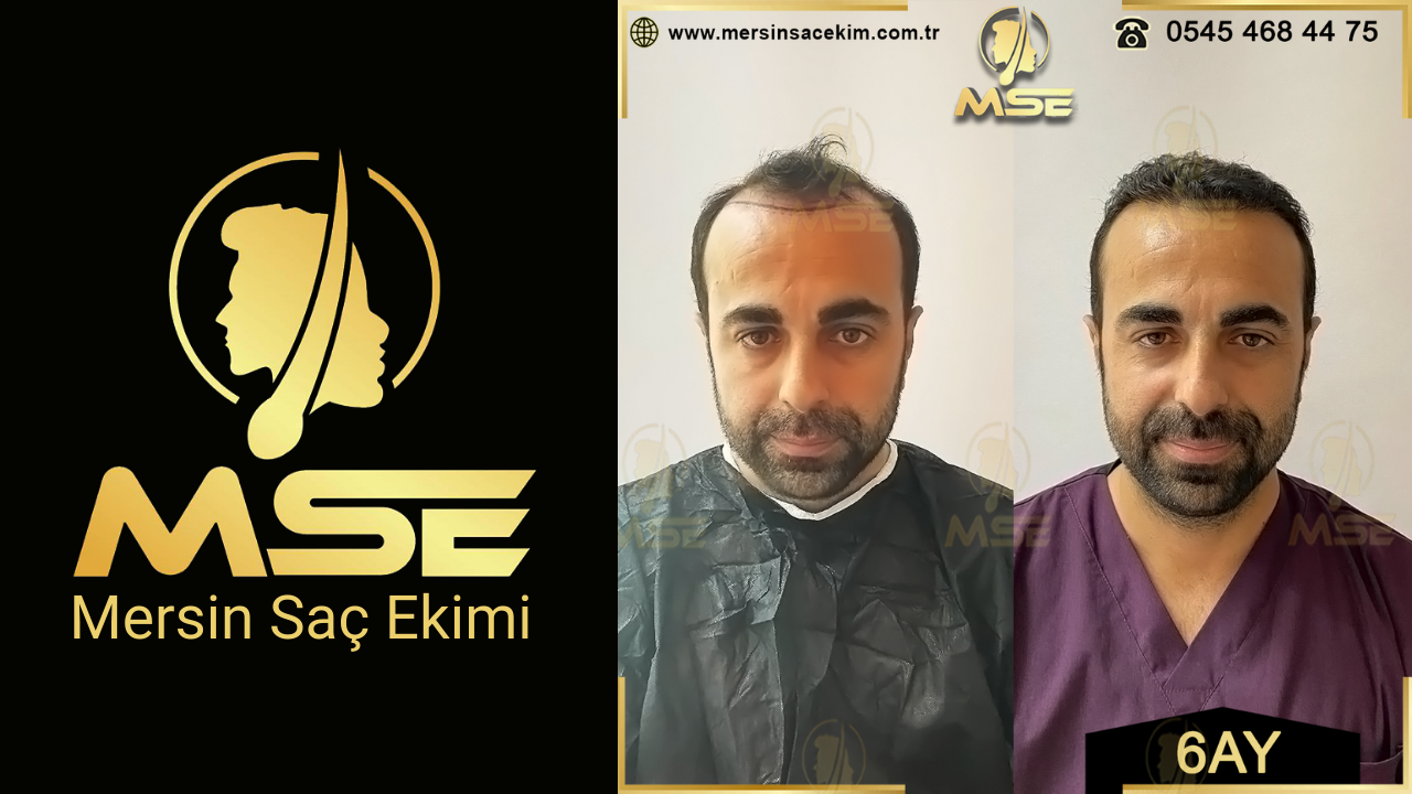 Mersin Saç Ekimi